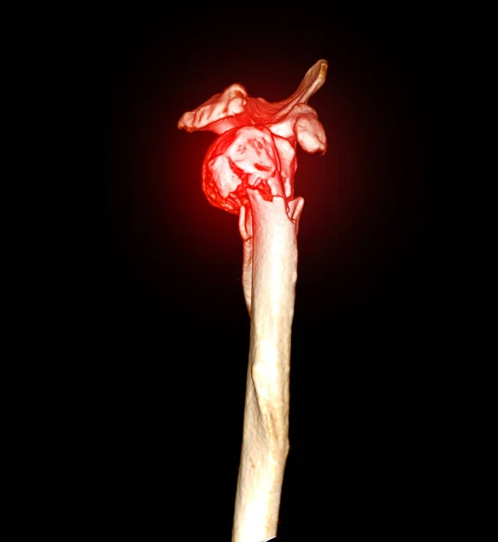 Tomografide Sol Omzun Görüntülemesi Kol Kemiğinin Kırık Olduğunu Gösteriyor — Stok fotoğraf