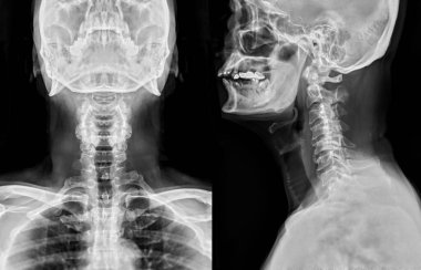 X-ray C-spine or x-ray image of Cervical spine AP and Lateral view for diagnostic intervertebral disc herniation ,Spondylosis and fracture. clipart