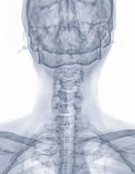 X-ray C-spine or x-ray image of Cervical spine lateral view for diagnostic intervertebral disc herniation ,Spondylosis and fracture.