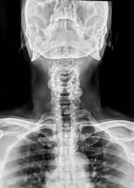 Röntgen Wirbelsäule Oder Röntgenbild Der Halswirbelsäule Seitenansicht Für Diagnostische Bandscheibenvorfälle — Stockfoto
