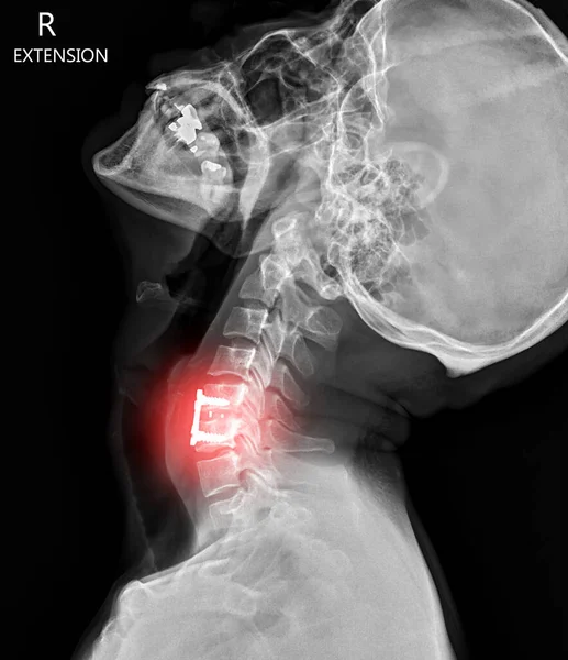 X-ray C-spine or x-ray image of Cervical spine lateral view showing fixed screw.