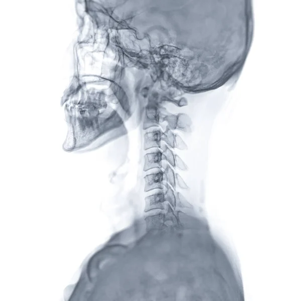 X-ray C-spine or x-ray image of Cervical spine lateral view for diagnostic intervertebral disc herniation ,Spondylosis and fracture.