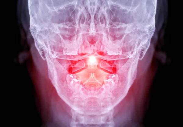Imagem Raio Coluna Vertebral Cervical Vista Aberta Para Fractura Vértebra — Fotografia de Stock