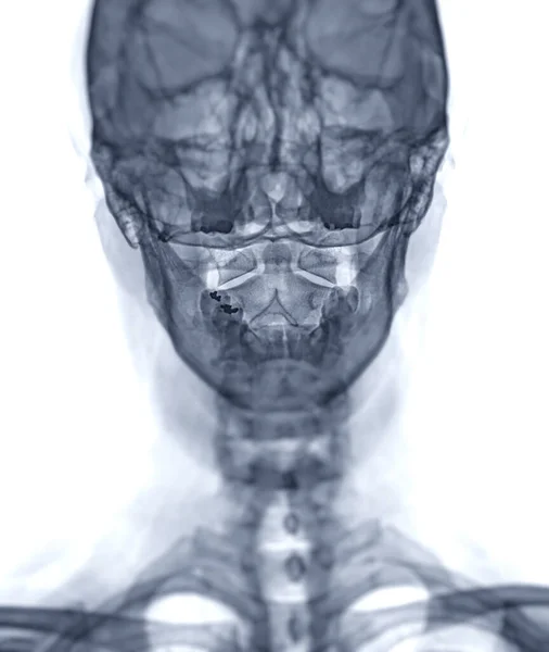 Röntgen Wirbelsäule Oder Röntgen Aufnahme Der Halswirbelsäule Offene Einfassung Für — Stockfoto