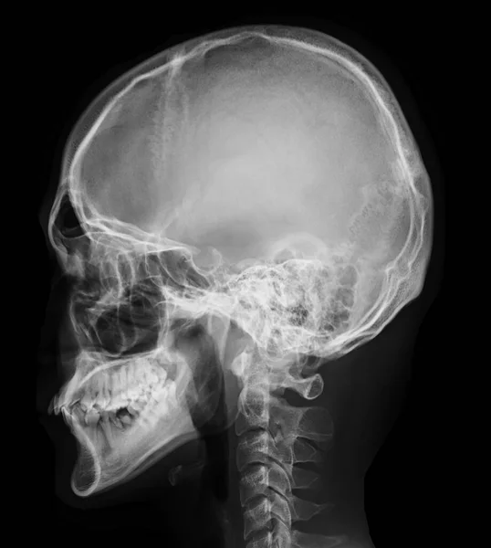 stock image  x-ray image of Human Skull   lateral view for diagnosis skull fracture  isolated on Black Background.