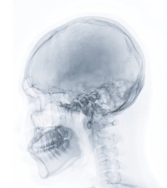 Ακτινογραφία Εικόνας Του Ανθρώπινου Κρανίου Πλευρική Άποψη Για Διάγνωση Κάταγμα — Φωτογραφία Αρχείου