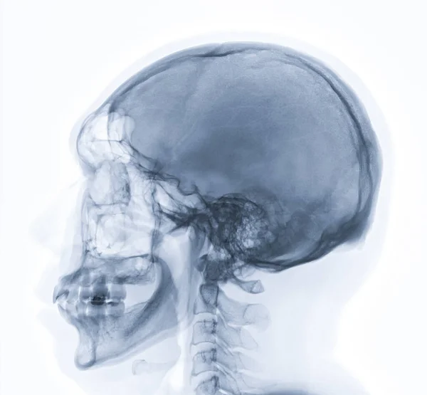 Рентгенівське Зображення Бічного Вигляду Черепа Людини Діагностики Перелому Черепа Ізольовано — стокове фото