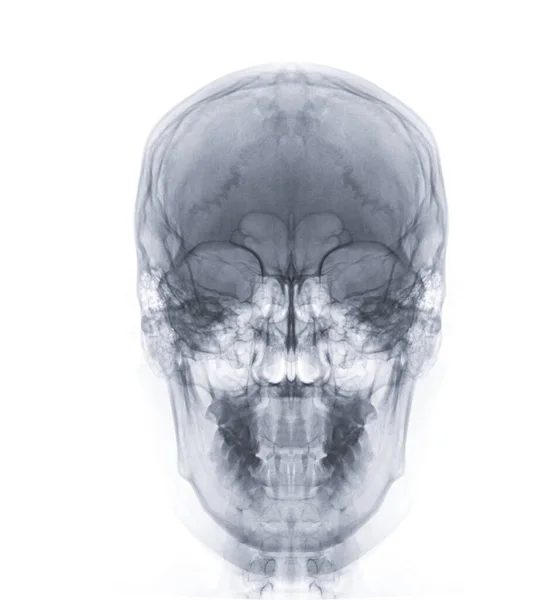 Рентгеновское Изображение Переднего Вида Черепа Человека Диагностики Перелома Черепа Изолированного — стоковое фото