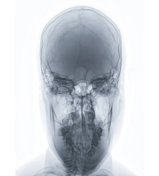 Imagen Rayos Vista Ciudad Human Skull Para Diagnóstico Fractura Cráneo — Foto de Stock