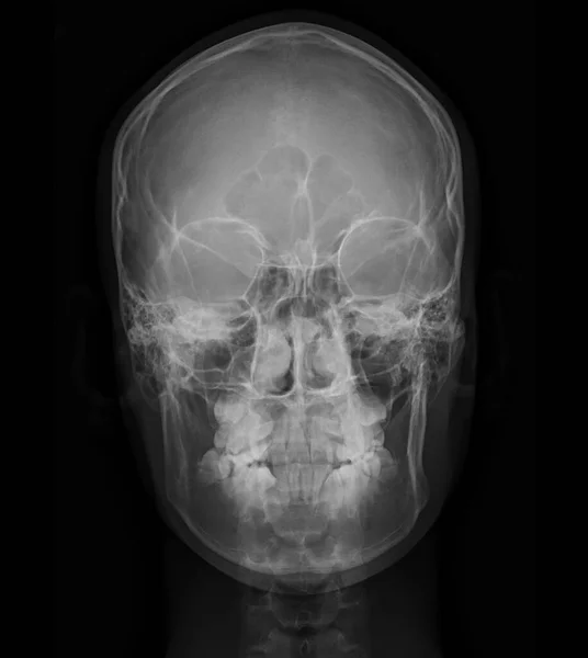 Image Radiographique Crâne Humain Vue Face Pour Diagnostic Fracture Crâne — Photo