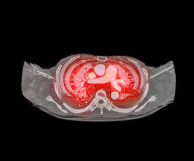 CTA pulmoner arterler 3D görüntüleme pulmoner arter dalı