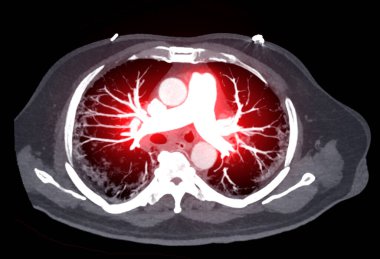 CTA pulmoner arterler 3D görüntüleme pulmoner arter dalı