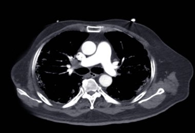 CTA pulmoner arterler 3D görüntüleme pulmoner arter dalı
