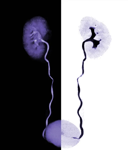 Cta Imagen Renderizado Arteria Renal Que Muestra Ambos Riñones Uréter — Foto de Stock