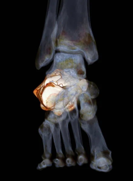 Ct扫描踝关节三维重建跟骨显示跟骨骨折 — 图库照片