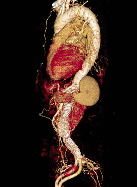 Hasta Abdominal Aort Anevrizmasında Stent Nakli Yapılan Aort Tomografisi — Stok fotoğraf