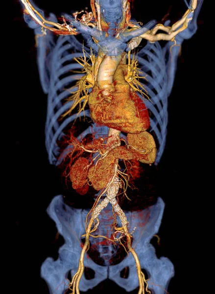 患者にステントグラフトを有する大動脈のCta 腹部大動脈瘤 — ストック写真