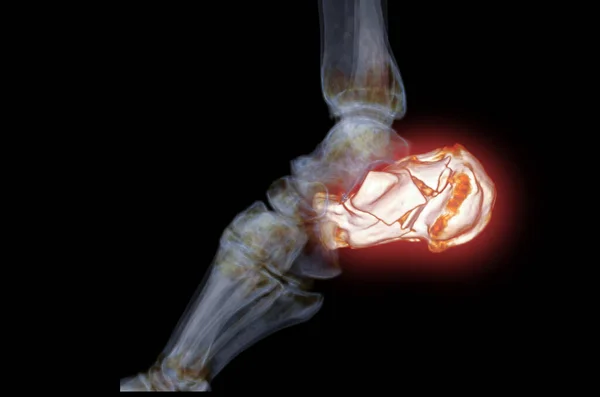 Ct扫描踝关节三维重建跟骨显示跟骨骨折 — 图库照片