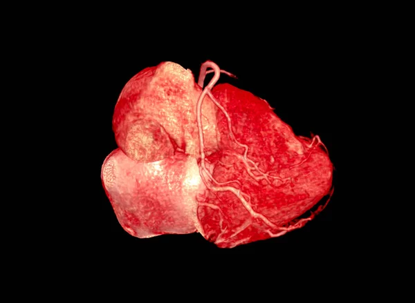 Cta冠動脈3Dレンダリング画像 — ストック写真