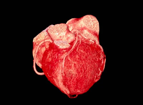 Cta冠動脈3Dレンダリング画像 — ストック写真