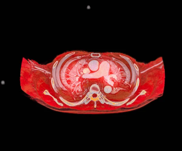 Cta肺動脈肺動脈の分岐を示す3Dレンダリング — ストック写真