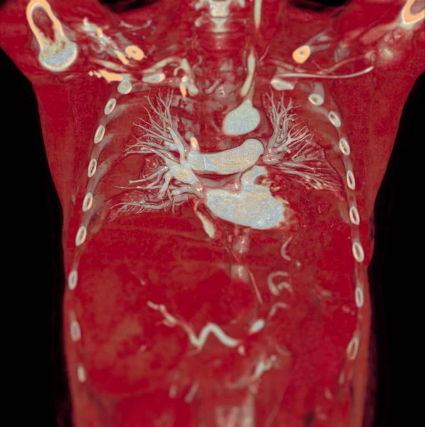 Cta Πνευμονικές Αρτηρίες Απόδοση Δείχνει Κλάδο Της Πνευμονικής Αρτηρίας — Φωτογραφία Αρχείου