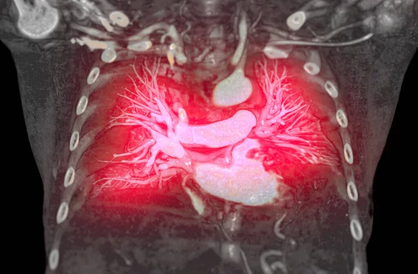 Cta肺动脉三维显像显示肺动脉分支 — 图库照片
