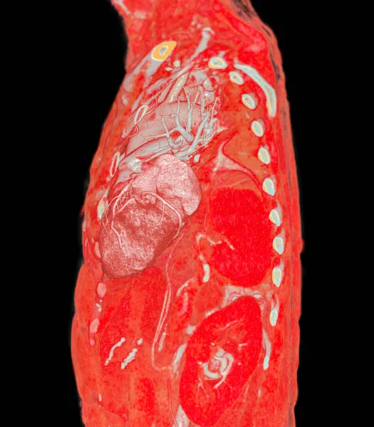 Arteria Polmonare Cta Rendering Che Mostra Ramo Dell Arteria Polmonare — Foto Stock