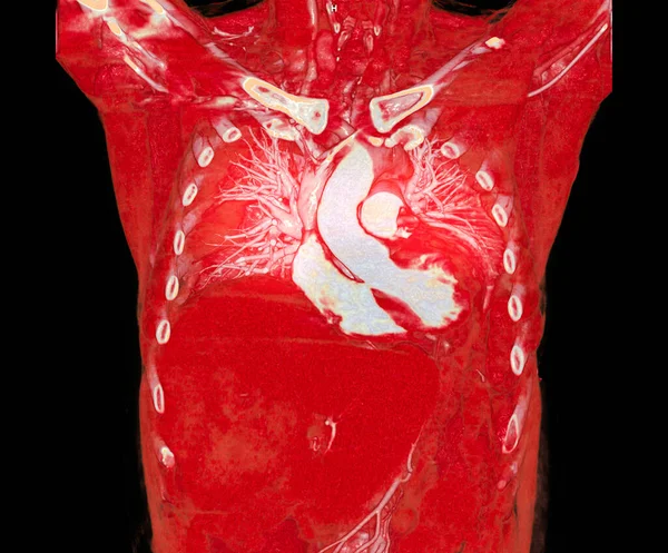 Cta Tętnic Płucnych Renderowania Pokazując Gałąź Tętnicy Płucnej — Zdjęcie stockowe