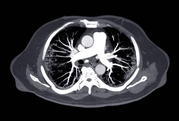 Cta Artérias Pulmonares Renderização Mostrando Ramo Artéria Pulmonar — Fotografia de Stock