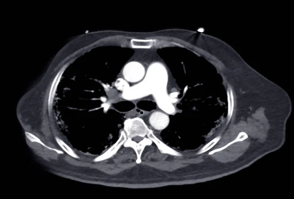 Cta Lungenarterien Rendering Das Ast Der Lungenarterie Zeigt — Stockfoto