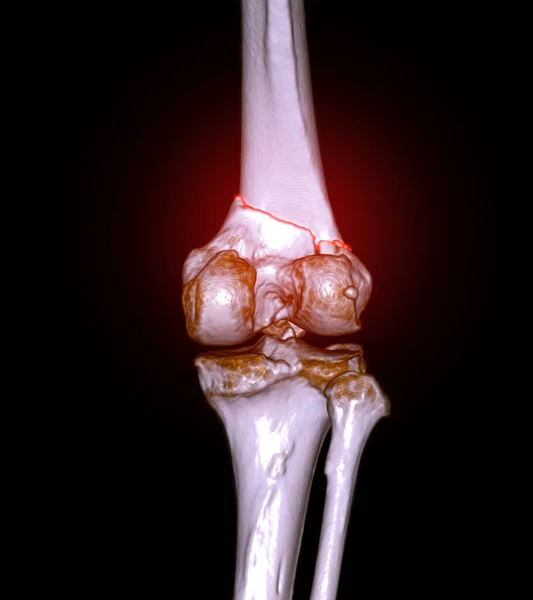 Сканування Колінного Суглоба Зображення Показує Перелом Дистальної Кістки Стегнової Кістки — стокове фото
