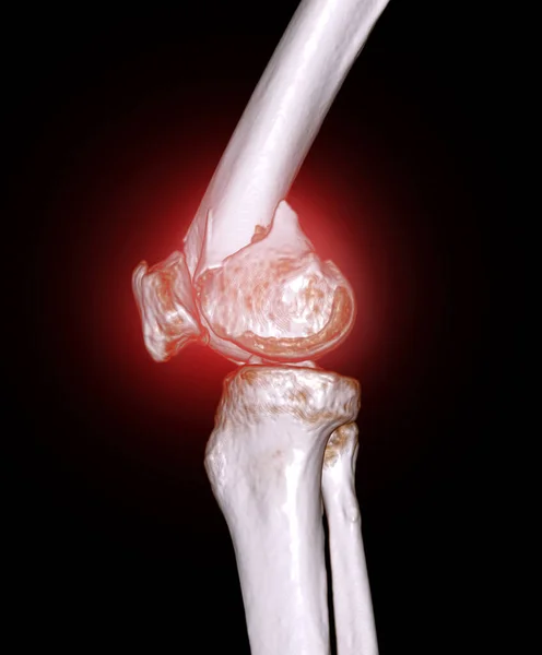 Skan Stawu Kolanowego Obraz Przedstawiający Złamanie Kości Udowej Dystalnej — Zdjęcie stockowe