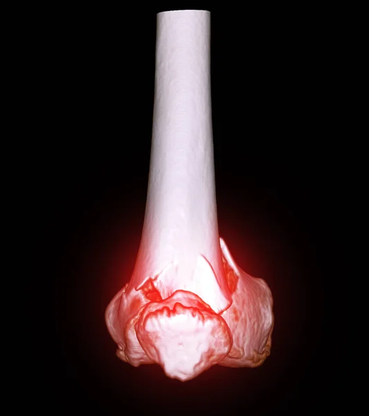 膝关节三维Ct扫描显示股骨远端骨折的影像 — 图库照片