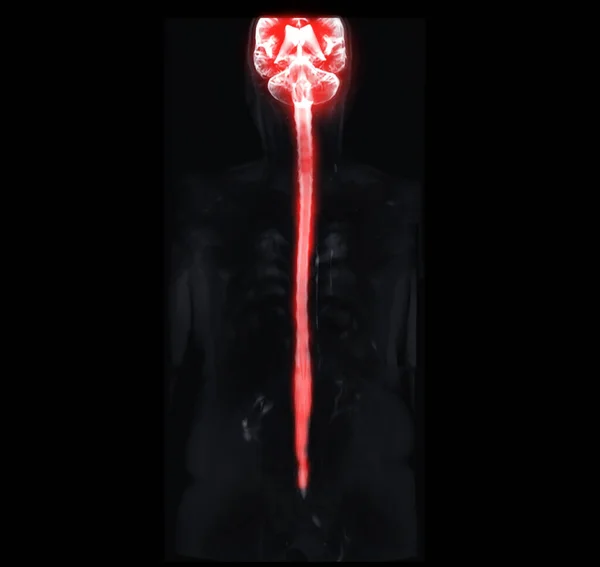 Mri Ολόκληρης Σπονδυλικής Στήλης Που Δείχνει Νωτιαίο Μυελό — Φωτογραφία Αρχείου