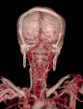  CTA brain and carotid artery or CT angiography of the brain  3D Rendering image . clipart