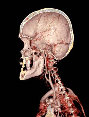  CTA beyin ve karotid arter veya beyin anjiyografisi 3D görüntüleme .