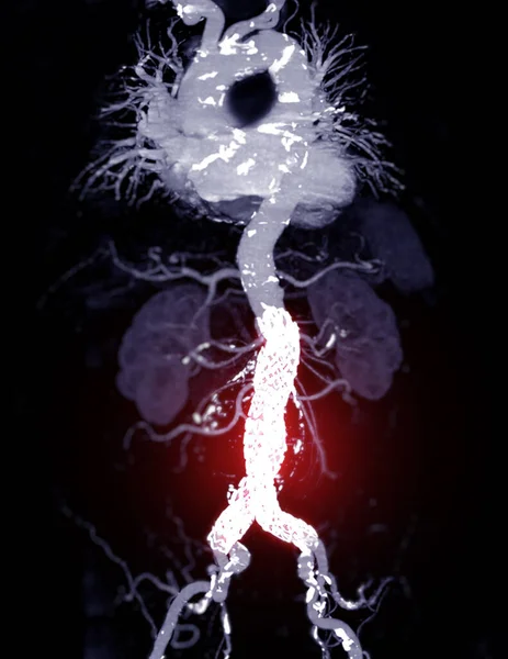 Cta Целая Аорта Абдоминальной Аортой Стент Трансплантата Рендеринг Изображения Случае — стоковое фото