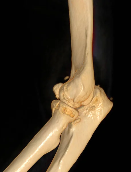 Scan Elbow Joint Rendering — Stock Photo, Image