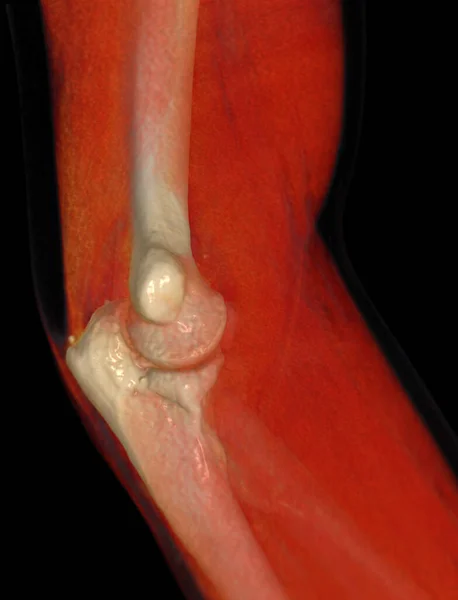Dirsek Ekleminin Tomografisi Görüntüleme — Stok fotoğraf