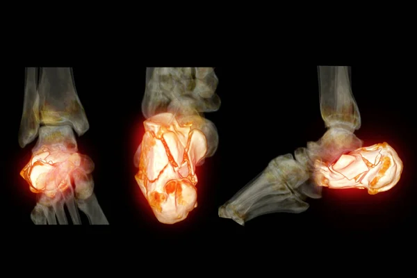 Ctカルカネウス骨 かかと骨 骨折を示すカルカネウス骨の3Dレンダリングと一緒に足首をスキャンします — ストック写真