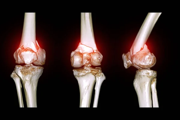 膝关节三维Ct扫描显示股骨远端骨折的影像 — 图库照片
