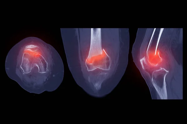 膝関節3Dレンダリング画像のCtスキャン遠位大腿骨骨骨折を示す — ストック写真