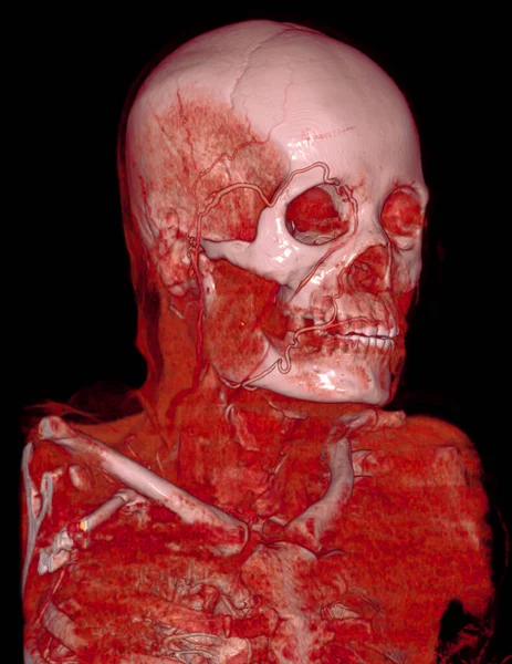Cta Brain Carotid Artery Angiography Brain Rendering Image — Stock Photo, Image