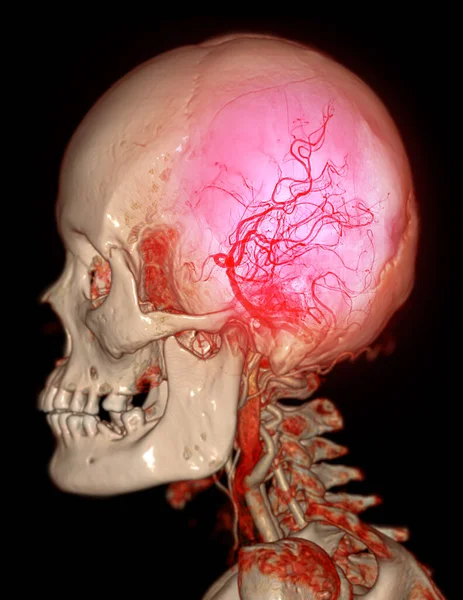 Cta Cervello Arteria Carotidea Angiografia Del Cervello Rendering Immagine — Foto Stock