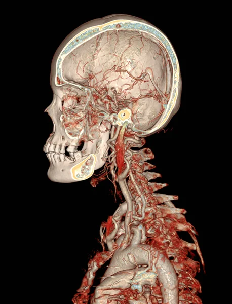 Cta脑 颈动脉造影或脑三维成像的Ct血管造影 — 图库照片