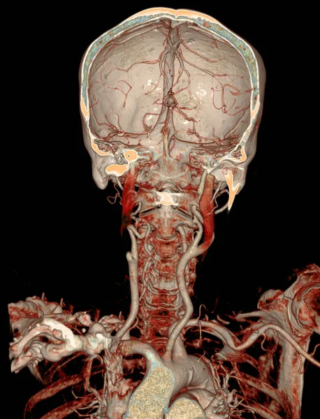 脳のCta脳と心臓動脈またはCt血管造影3Dレンダリング画像 — ストック写真