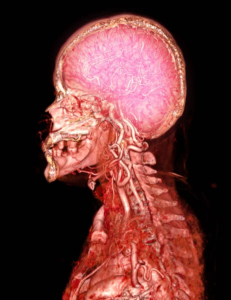 脳のCta脳と心臓動脈またはCt血管造影3Dレンダリング画像 — ストック写真