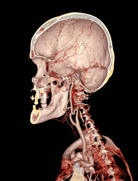 Cta脑 颈动脉造影或脑三维成像的Ct血管造影 — 图库照片
