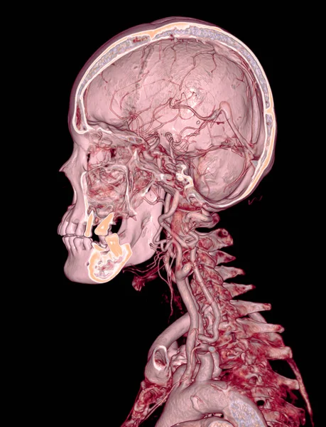 Cta Мозку Сонної Артерії Або Ангіографії Мозку Зображення Рендеринга — стокове фото